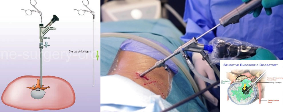 endoscopic-spine-surgery